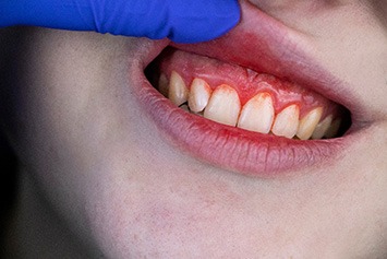 A closeup of a bleeding and inflamed gum tissue