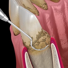 A 3D illustration of scaling and root planing