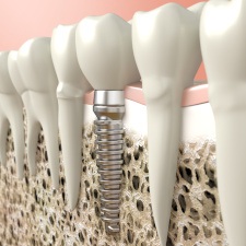 Digital illustration of a dental implant