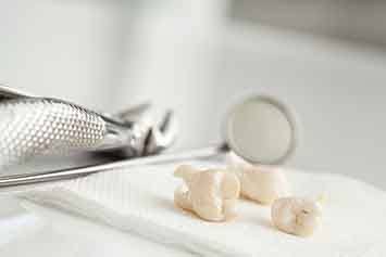 Extracted teeth on a napkin next to forceps and dental mirror