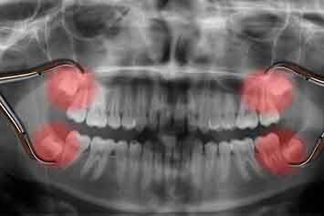 X-ray image with 4 wisdom teeth highlighted in red