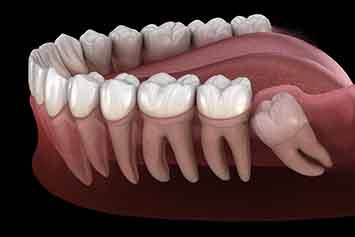 Rendering of an impacted wisdom tooth in a lower arch