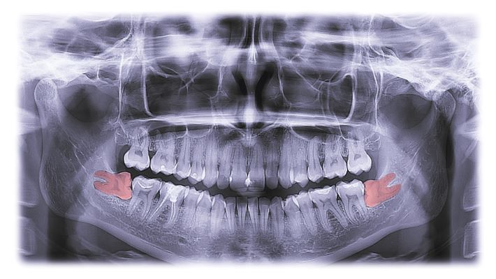 An X-ray image of wisdom teeth.